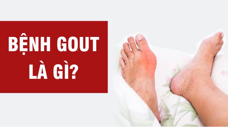 Bệnh gout và những điều cần biết