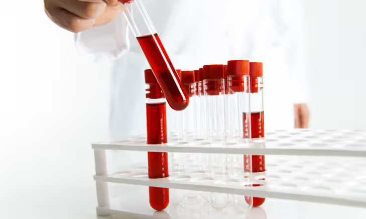 Xét nghiệm Aldosterone bằng mẫu máu