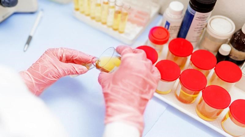 Xet-nghiem-Catecholamine-nuoc-tieu-24-gio