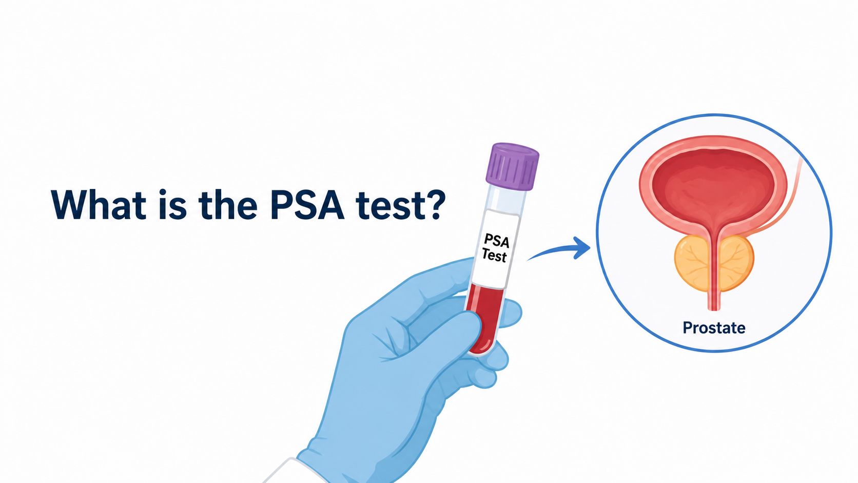 What is the PSA test