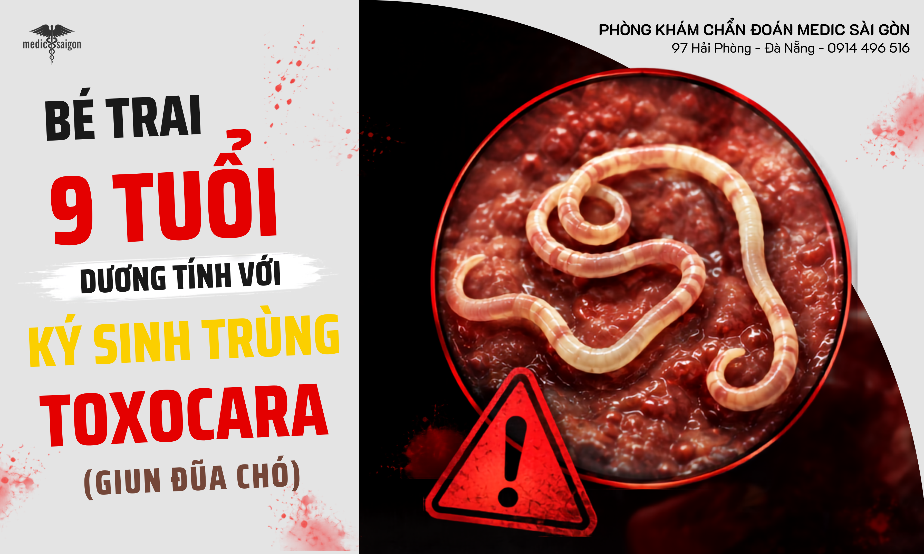 Bé trai 9 tuổi dương tính với giun đũa chó