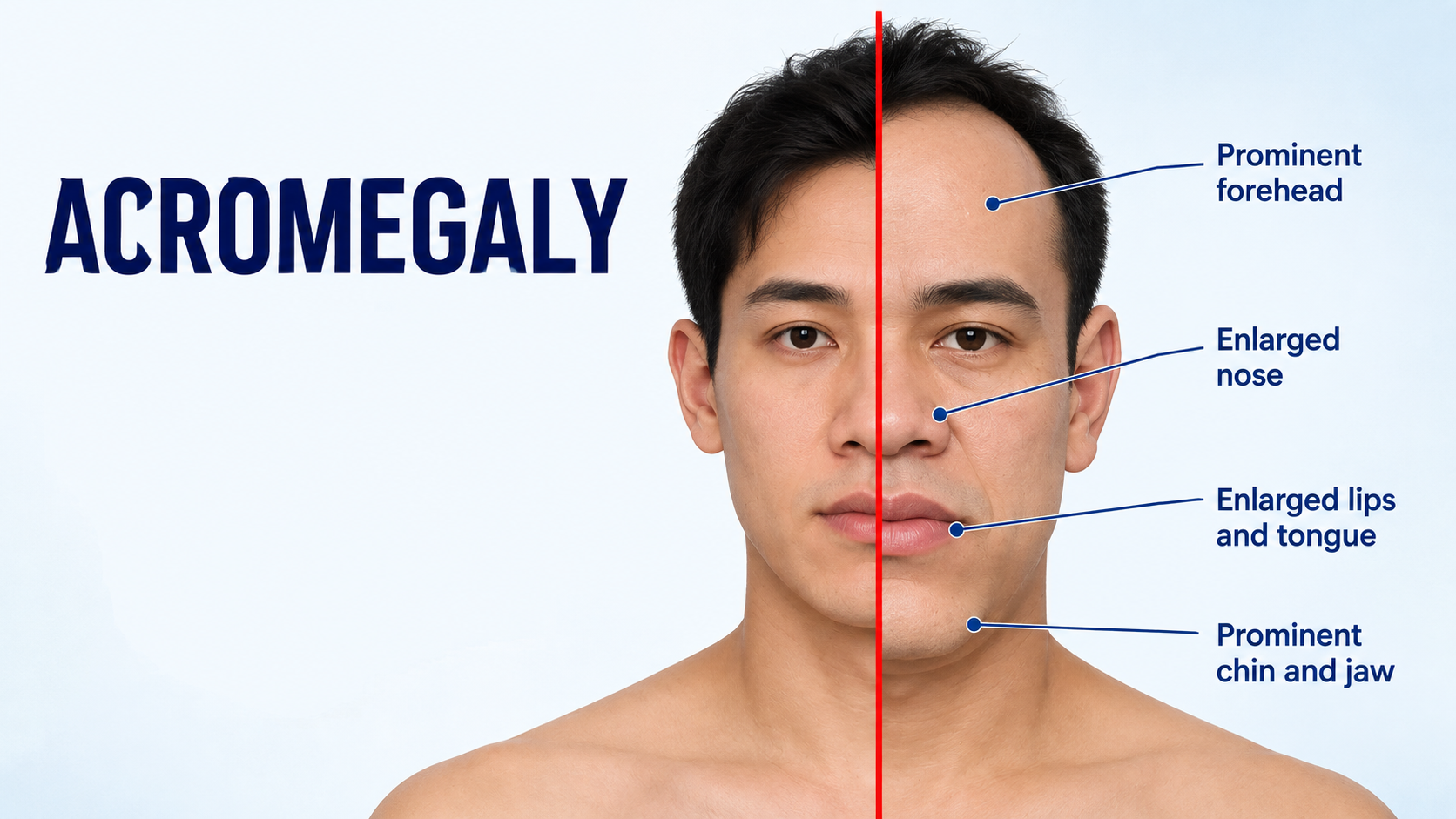 Abnormally high levels of this hormone in adults can easily lead to acromegaly
