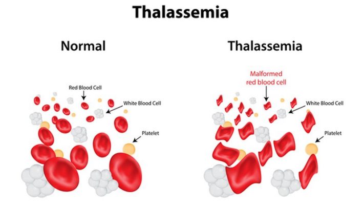 tan-mau-bam-sinh-hong-Thalassemia