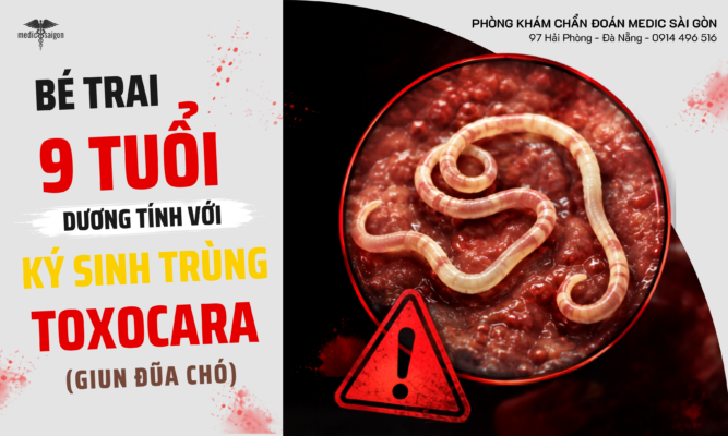 Bé trai 9 tuổi dương tính với giun đũa chó